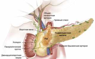 Рак поджелудочной железы: первые симптомы проявления, причины и лечение онкологии
