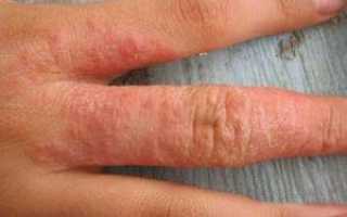Почему появляется сыпь в виде крапивницы на руках: симптомы с фото, лечение болезни