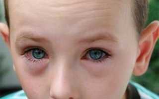 Что делать, если у ребенка отек глаз?