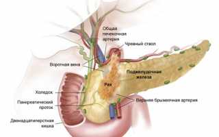 Фиброзные изменения в поджелудочной железе