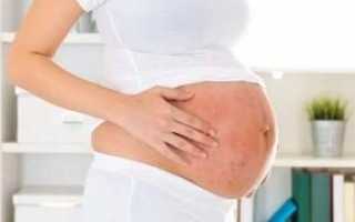 Существующие методы лечения псориаза у беременных женщин