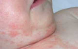 Контактная форма дерматита у детей: описание и способы лечения