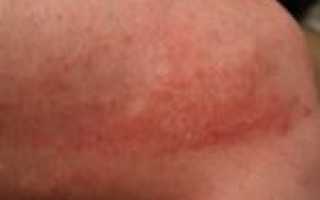 Аллергия на курагу: когда сушеный абрикос не приносит пользу