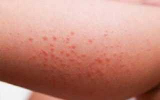Аллергия на кукурузную кашу у грудного ребенка — правда или выдумка?